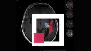 BioTechX – our brain tumor segmentation algorithm - Graylight Imaging